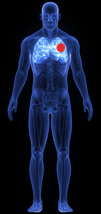 Human body icon outlining an example of the effects of tumor-selective immunotherapies for a person with lung cancer